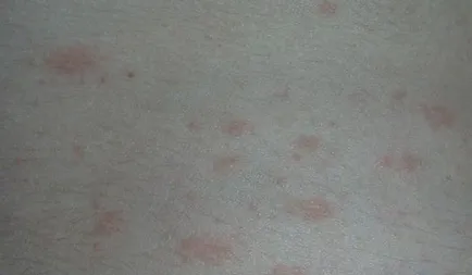 Малък тяло обрив от нещо