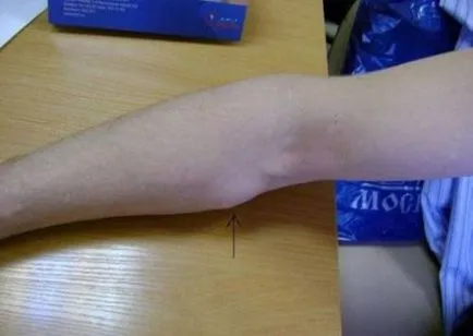 Пъпки по тялото от това, което