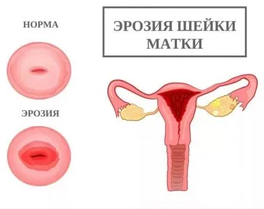 Ако селекцията като сопол