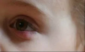 Chalazion лечение на дете
