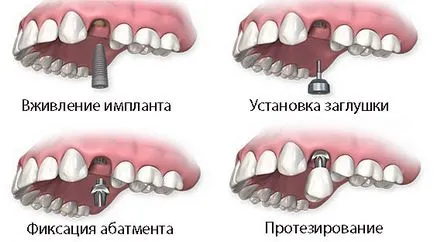 Задаване на импланти