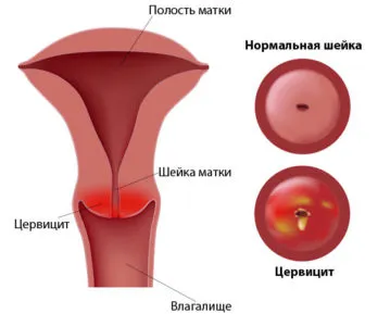 Ако селекцията като сопол