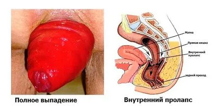 Ректално го пролапс