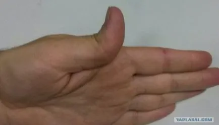 Какво да правите, ако изкълчен пръст