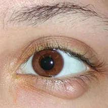 Chalazion лечение на дете