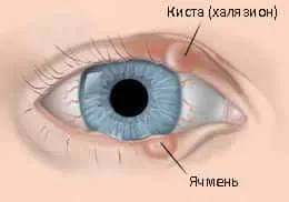 Chalazion лечение на дете