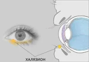Chalazion лечение на дете