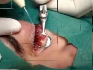 Chalazion лечение на дете