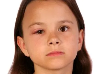 Chalazion лечение на дете