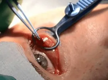 Chalazion лечение на дете