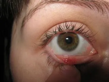 Chalazion лечение на дете