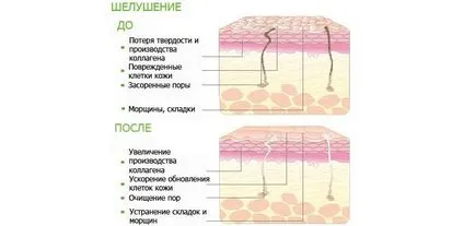 Пилинг мнения на кожата