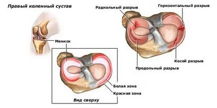Какви схрусква колене Какви схрусква колене