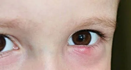 Chalazion лечение на дете