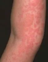 Червени петна по краката го