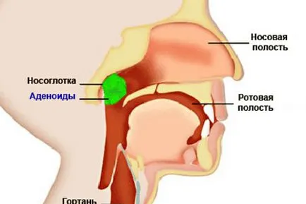 Третираните аденоидите при децата