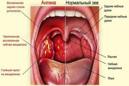 Третираните аденоидите при децата