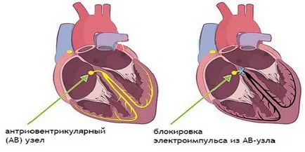 Какво е непълен сърдечен блок Какво е непълен сърдечен блок