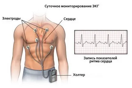 Какво е непълен сърдечен блок