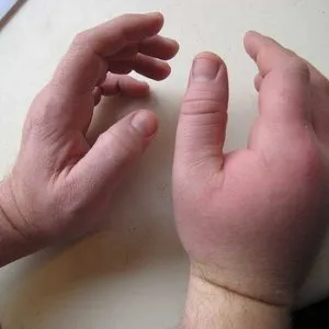 лечение паронихия
