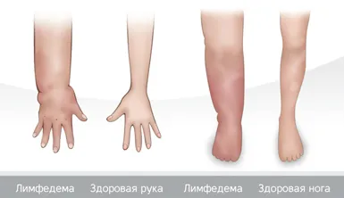 Какво е lymphostasis крака