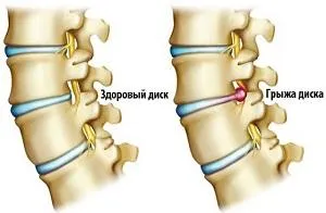 Какво е дискова херния