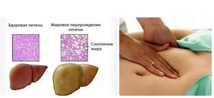 Какво е чернодробна стеатоза лечение Какво е чернодробна стеатоза лечение