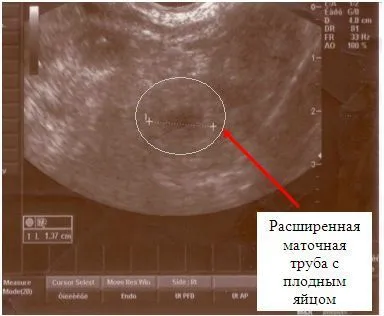 Как да се открие бременност в ранна бременност