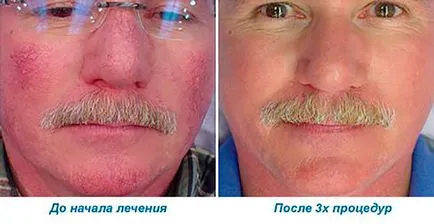 Как да се отървем от кръвоносните съдове по лицето