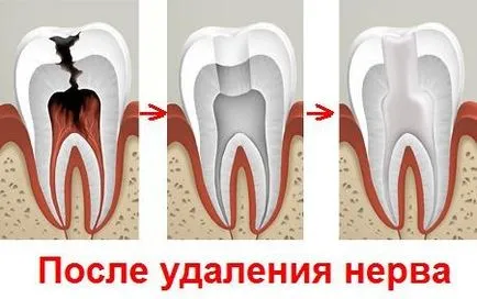 Убие нерв в зъба от