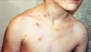Варицелата е как изглежда