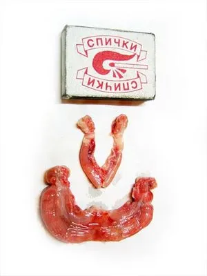 Как да се лекува зъб дете