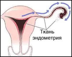 хроничен ендометрит лечение на народната медицина