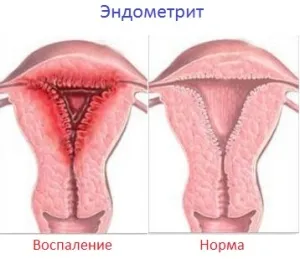 хроничен ендометрит лечение на народната медицина хроничен ендометрит лечение на народната медицина