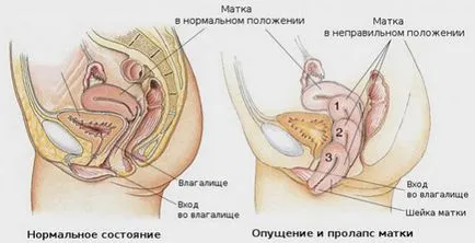 Какво е лапароскопия матката