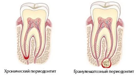 лечение пародонтит при деца лечение пародонтит при деца
