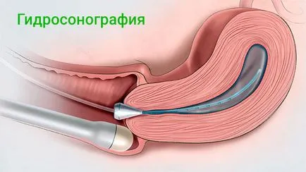 Какво е лапароскопия матката