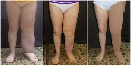 Какво е lymphostasis крака Какво е lymphostasis крака