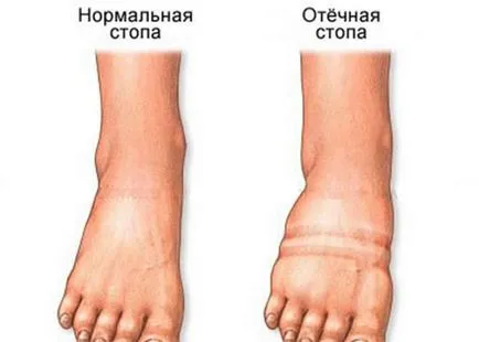 Какво е lymphostasis крака Какво е lymphostasis крака