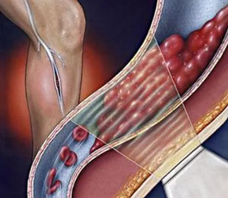 Какво е lymphostasis крака