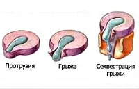 Какво е дискова херния