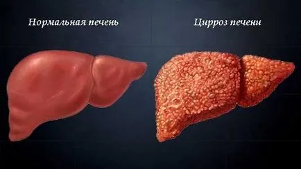 nemozolom лечение