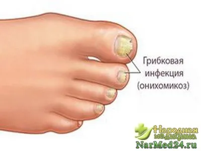 лечение на онихомикоза на ноктите