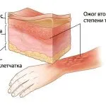 Това спред от изгореното