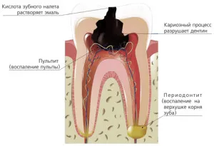 лечение пародонтит при деца
