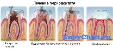 лечение пародонтит при деца лечение пародонтит при деца