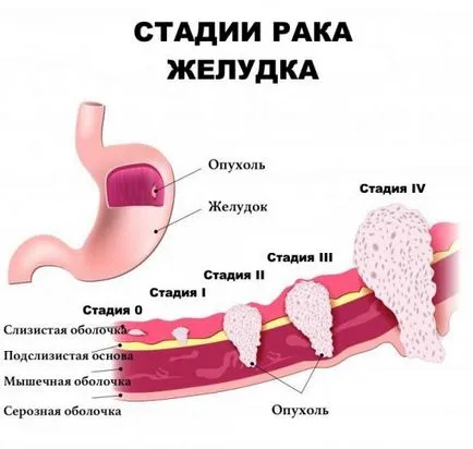 Végstádiumú rákos Végstádiumú rákos