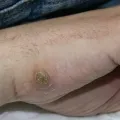 Как да премахнете брадавици