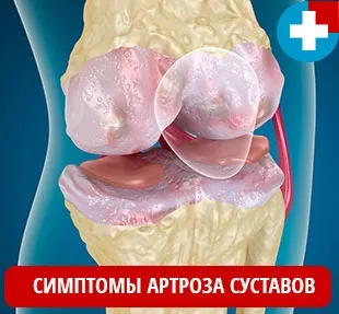 От това, което artropil От това, което artropil
