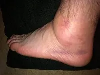 Какво е lymphostasis крака